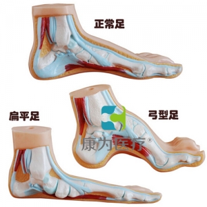 “康為醫(yī)療”正常足、扁平足、弓型足模型