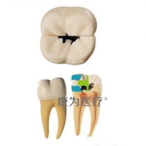 “康為醫(yī)療”磨牙蛀牙模型