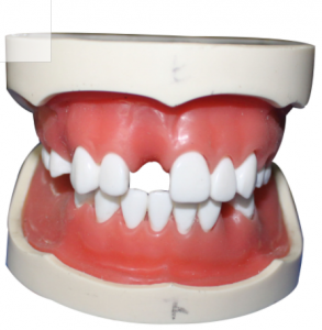 種植牙模型（含上、下頜）